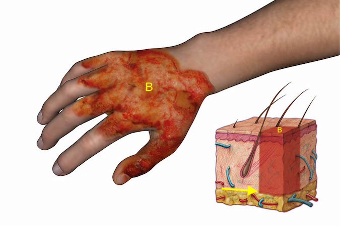 burns-hand-surgery-source